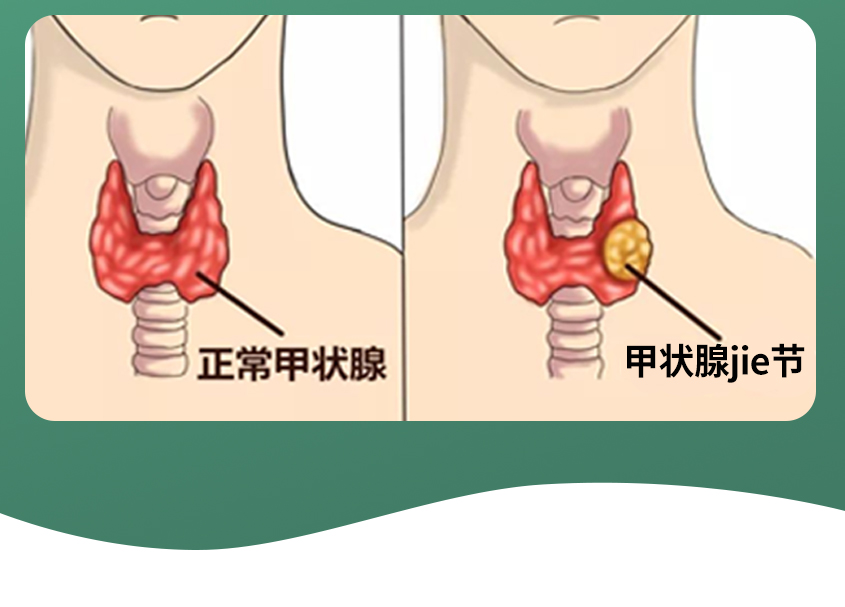 甲状腺详情--1_05.jpg