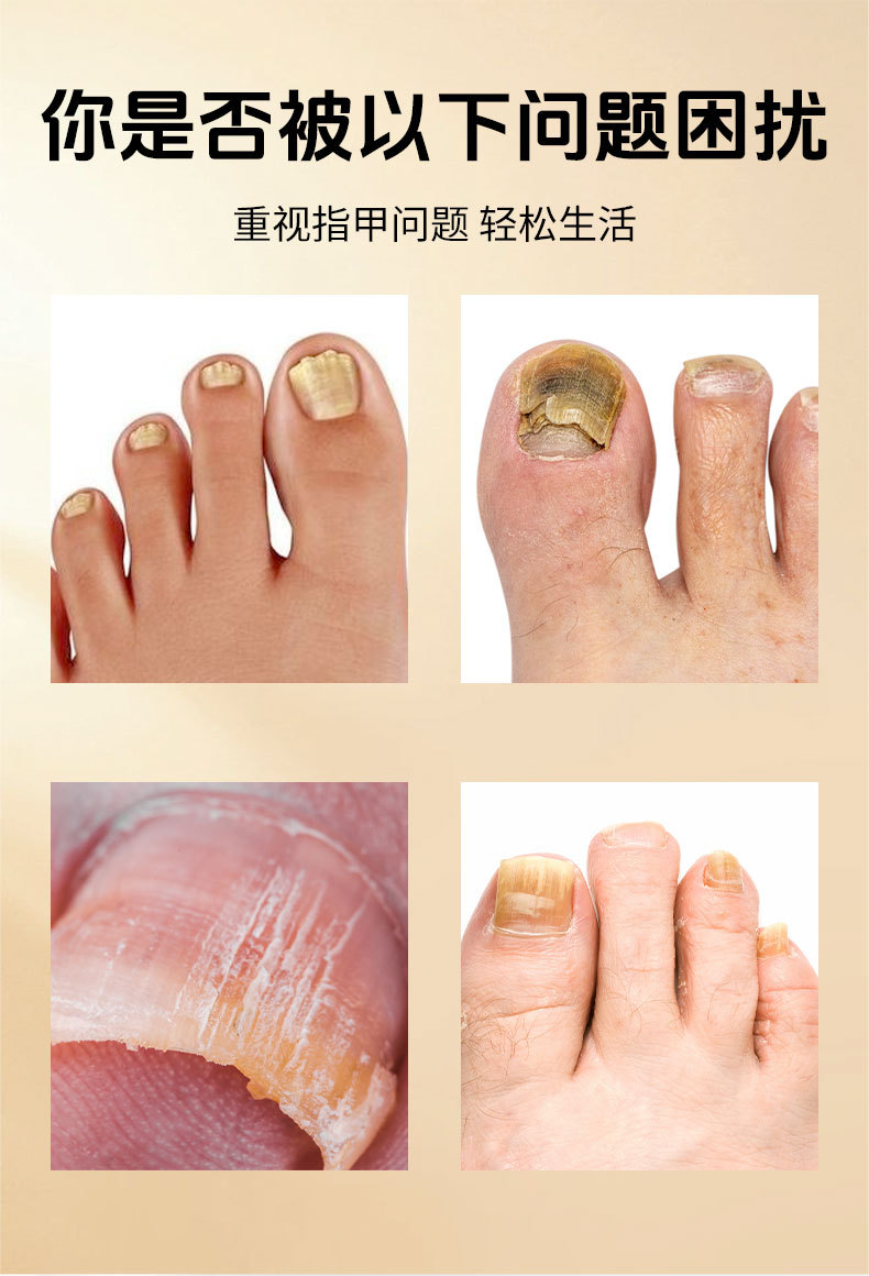 同仁堂灰甲宁滴剂凤仙花足部护理脱甲精油灰指甲去甲膏药水和甲膏