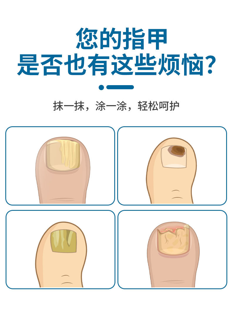 同仁堂灰甲宁家用凤仙花足部护理脱甲精油灰指甲去甲膏药水和甲膏