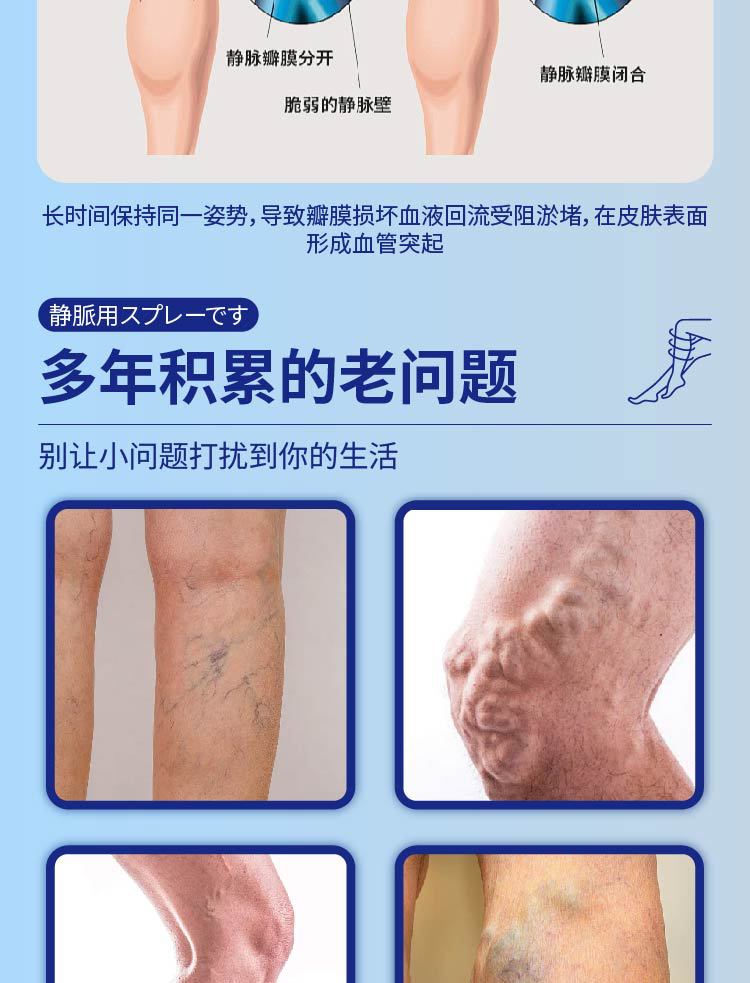 云南本草静脉舒喷剂静脉腿部青筋凸起曲张清金抑菌液蚯蚓腿血管肿