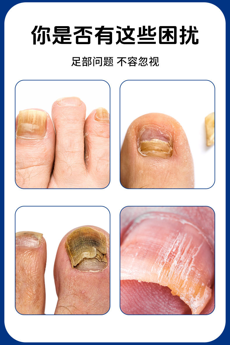 云南本草灰指甲泡脚凝珠浓缩免熬煮灰甲亮甲艾草草本泡脚原液批发
