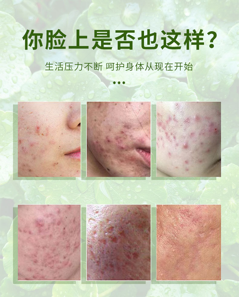 积雪草保健膏祛痘膏去粉刺膏修护痘印痘坑青春痘祛痘霜粉刺闭口保